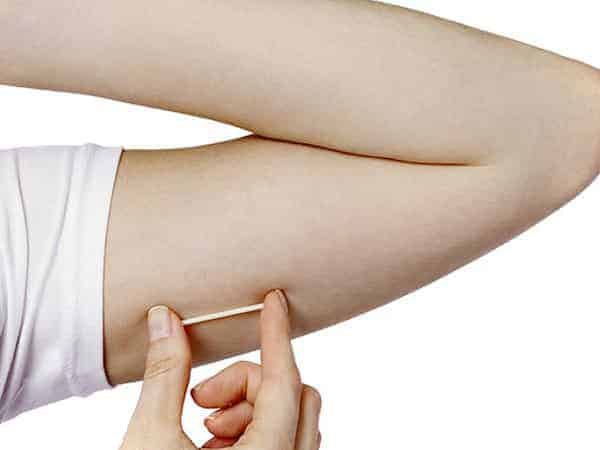 Contraceptive implant fitting removal melbourne